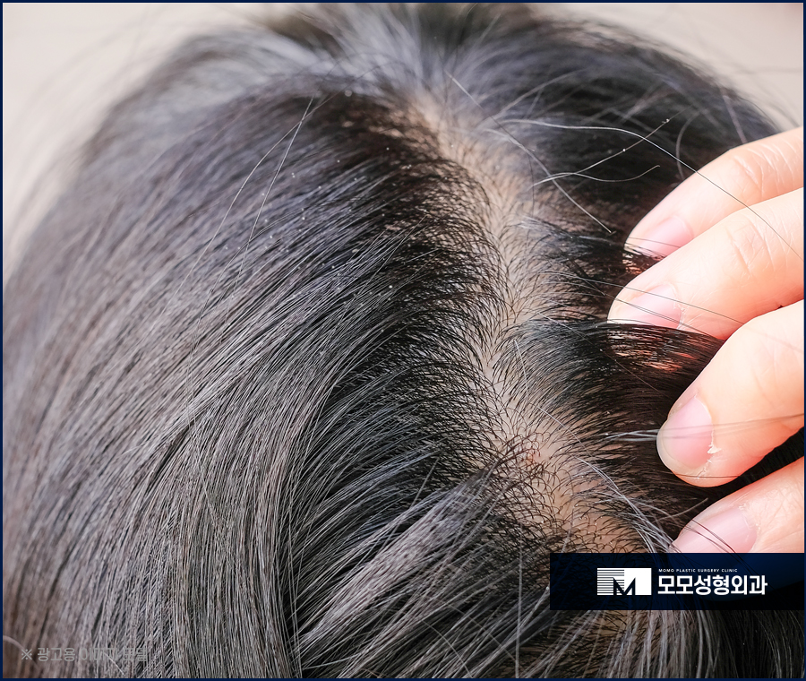 비듬이생기는이유와 해결을 위한 방법 관련 이미지 6