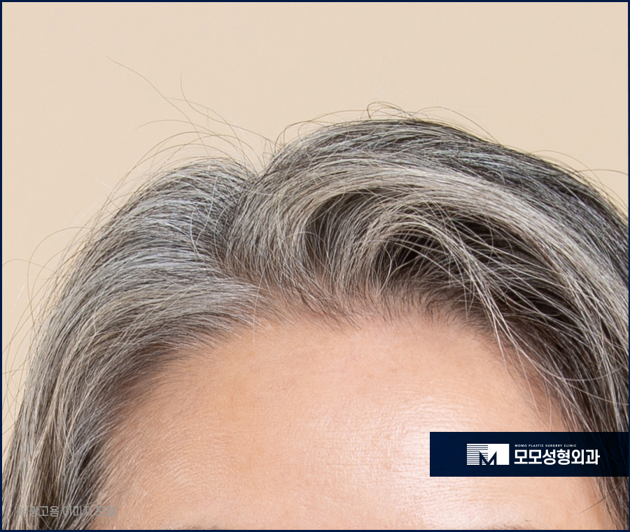 흰머리나는시기와 이유에 대해서 알아봅니다 관련 이미지 6