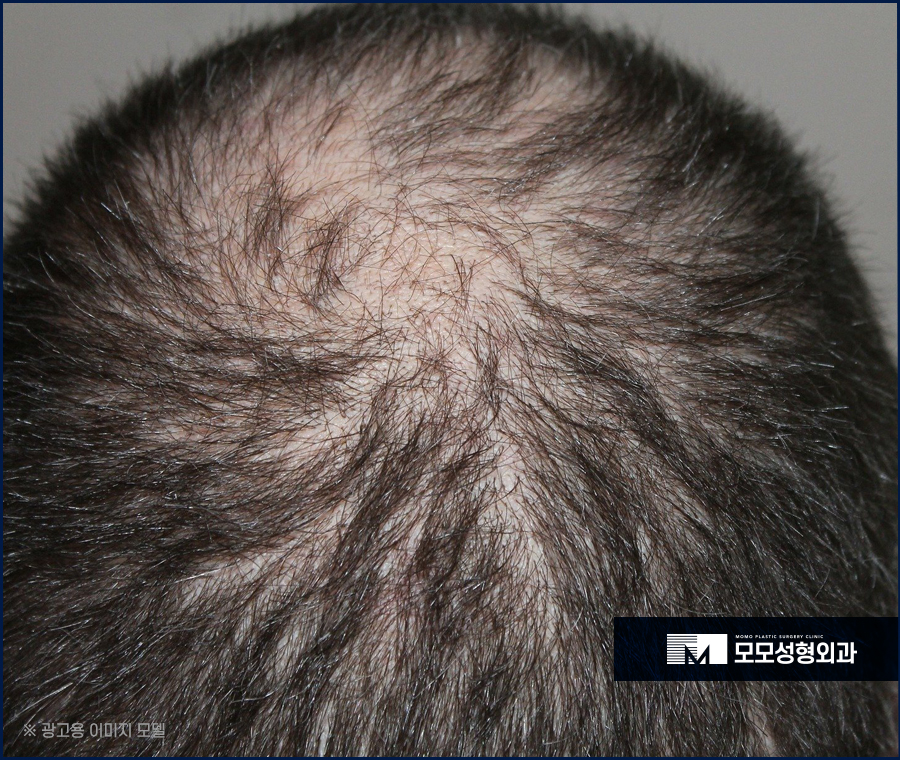 머리심기비용 방식에 따라 나뉘어지는 관련 이미지 3