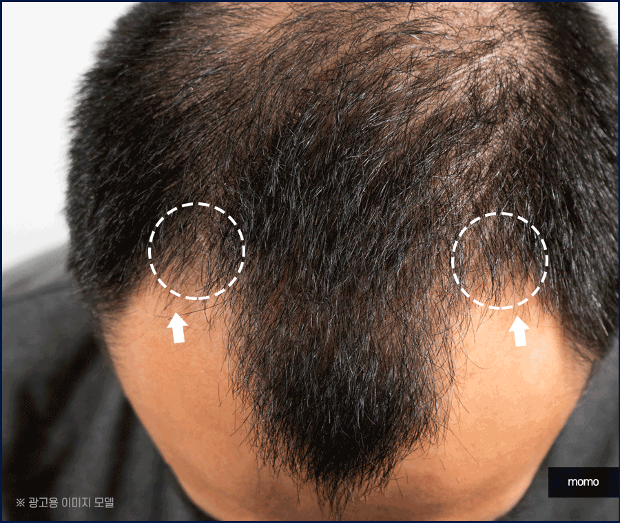 엠자이마 탈모 헤어라인 모발이식으로 관리하기 관련 이미지 7