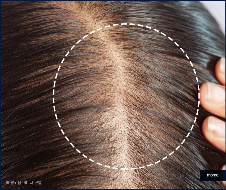 압구정 모발이식 건강한 두피를 만드는 방법 관련 이미지 10