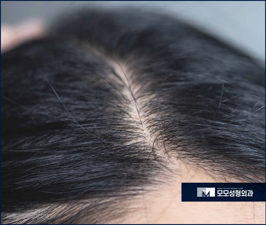 20대정수리탈모초기 신속한 대응이 중요합니다 관련 이미지 3