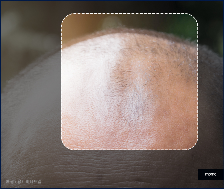 모발이식 절개 비절개 방법을 비교 분석해 가며 관련 이미지 11