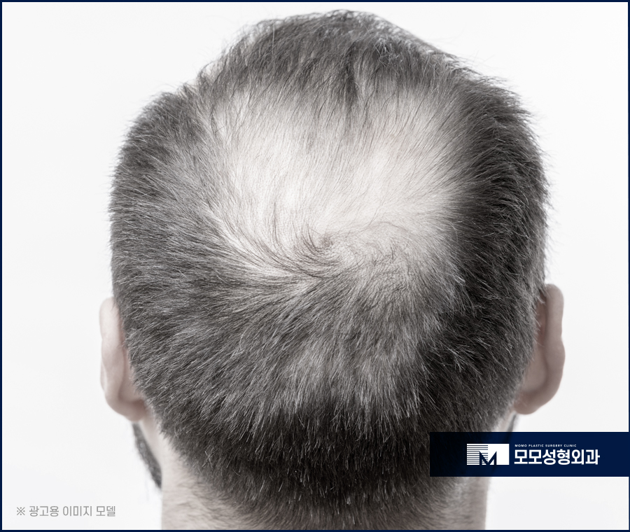 비절개모발이식가격 시작 전에 확인해 보는 관련 이미지 3