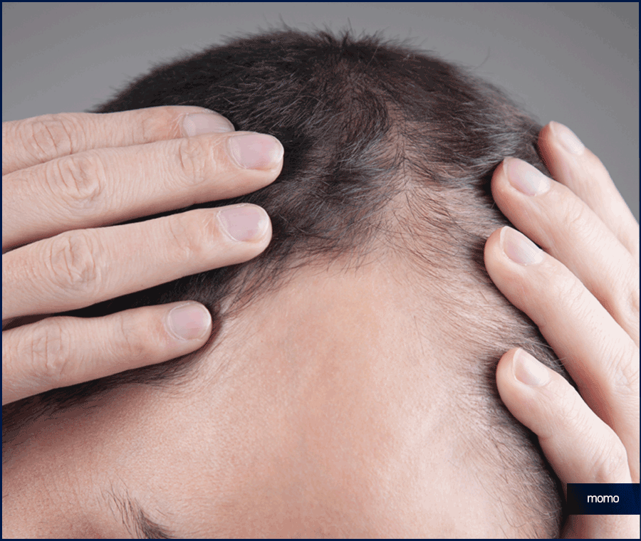 탈모 클리닉 비용의 기준이 되는 조건은? 관련 이미지 11