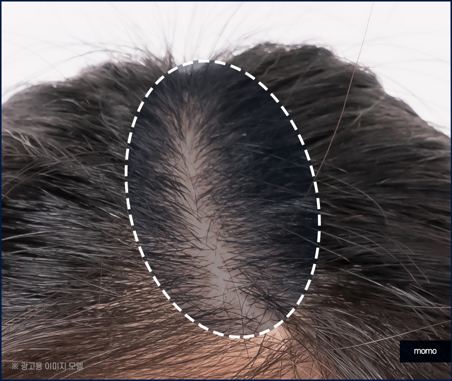 남자 가르마 탈모 진짜 내 머리처럼 채우려면 관련 이미지 3