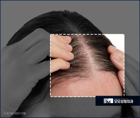 여자비절개모발이식 당당한 이마 라인을 뽐내도록 관련 이미지 4