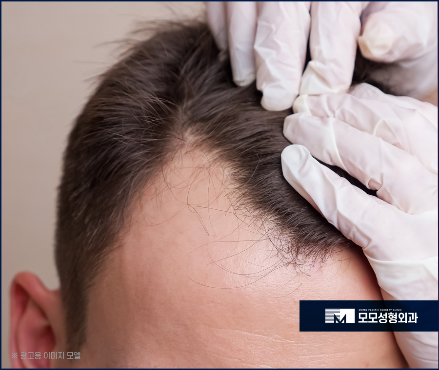 비절개모발이식가격 나에게 꼭 맞는 방향을 설정해서 관련 이미지 3