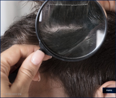 m자탈모초기 빠른 대처를 이뤄낸다면 관련 이미지 2