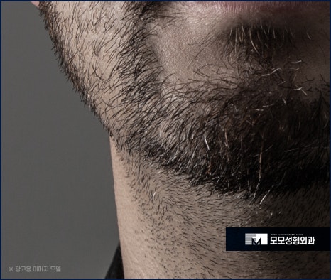 체모 이식 부위별 특성 고려해서 자연스런 결과로 관련 이미지 7