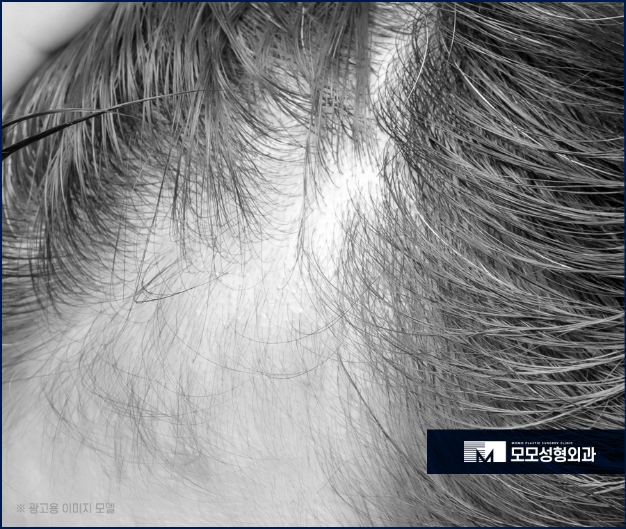 비절개모발이식가격 꼼꼼히 살펴보며 함께 체크할 점 관련 이미지 7