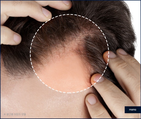 압구정 모발이식 외모 변화를 희망한다면 관련 이미지 4