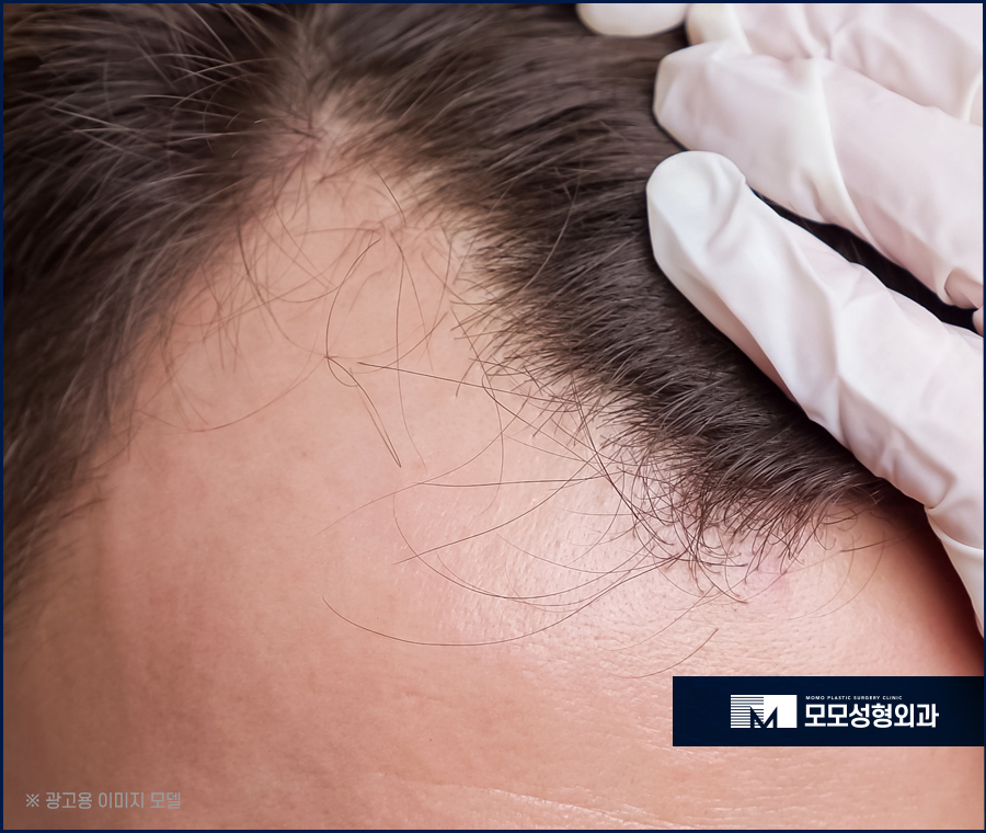 m자형 탈모 보완 시 꼭 짚어야 할 체크 포인트 (ft. 모발이식) 관련 이미지 6