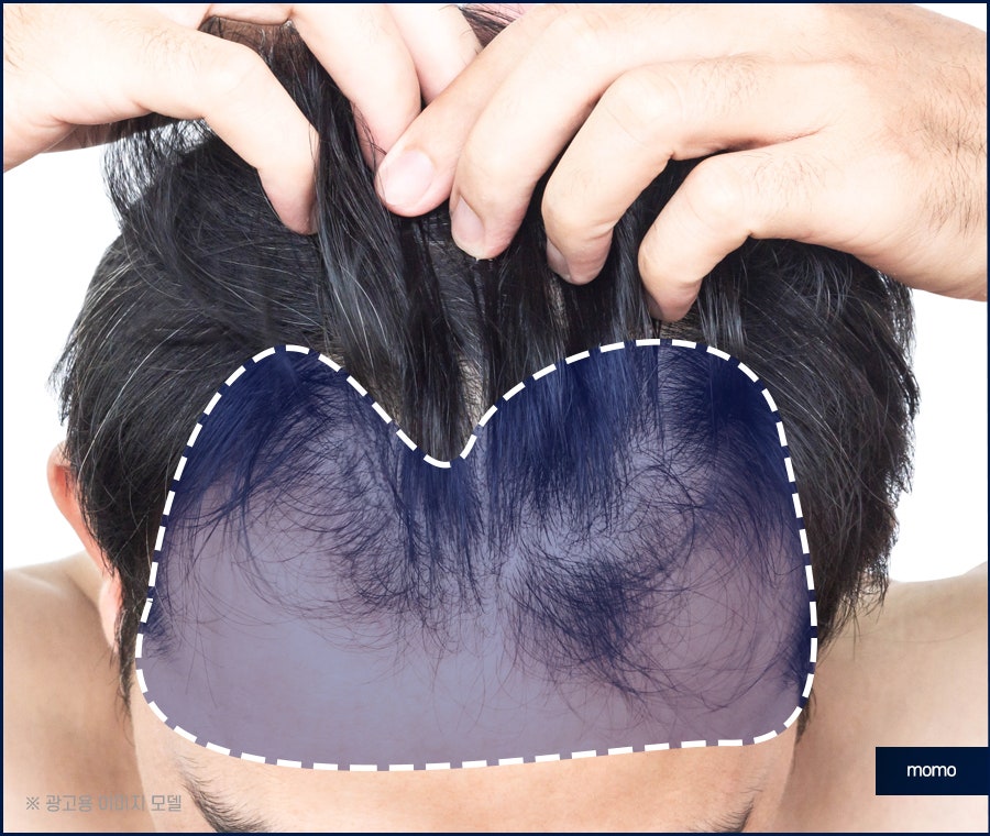 모발이식 생착률 극대화 하려면 관련 이미지 6