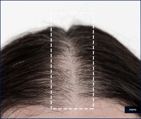 20대 원형탈모 효과적인 개선 방법은 관련 이미지 5