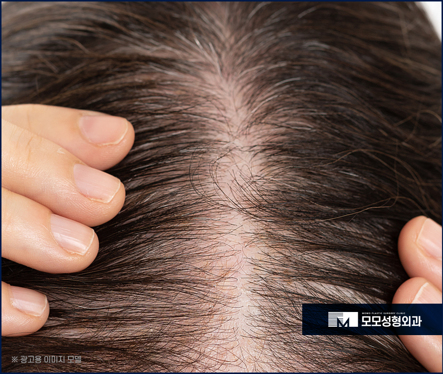 30대 정수리 탈모 초기 증상부터 대응 방법까지 관련 이미지 3
