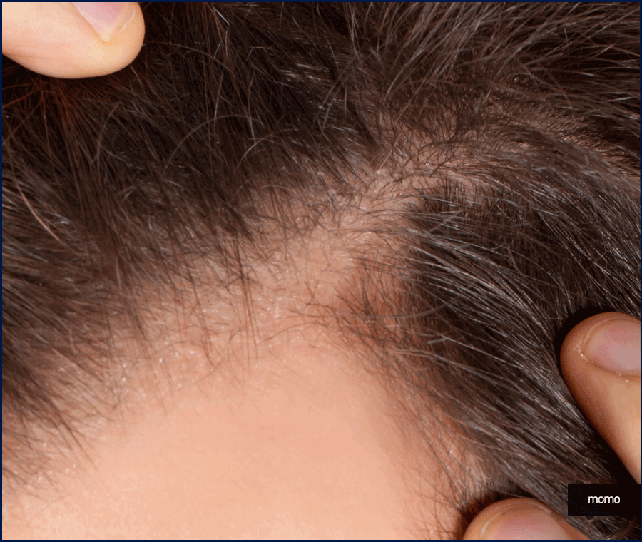 압구정 탈모병원 보완을 위한 최선책은? 관련 이미지 8