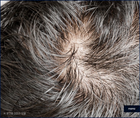 20대 원형탈모 효과적인 개선 방법은 관련 이미지 4