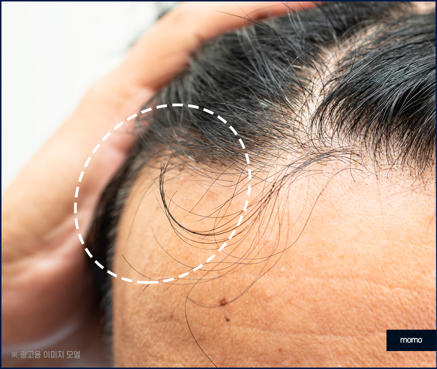 여자m자탈모 헤어라인 디자인까지 고려해 채우는 관련 이미지 4