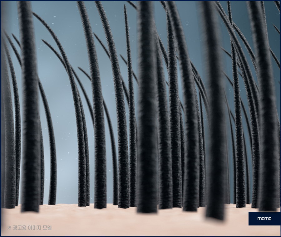 M자모발이식비용 가격 탈모 탈출을 위한 관련 이미지 2