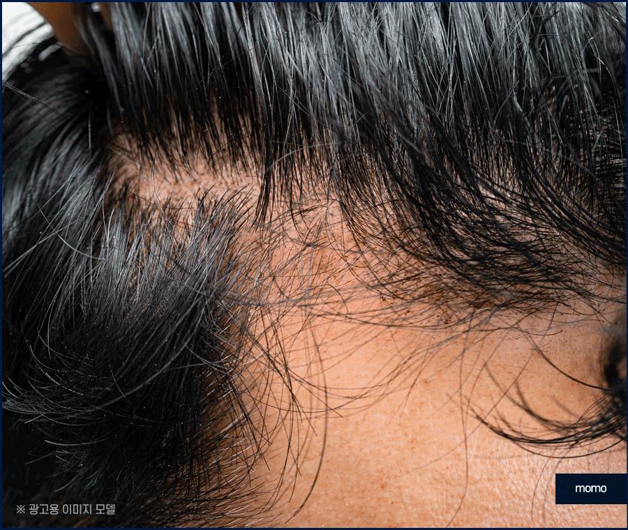 중학생탈모 발생 원인 및 보완하는 방법은? 관련 이미지 10