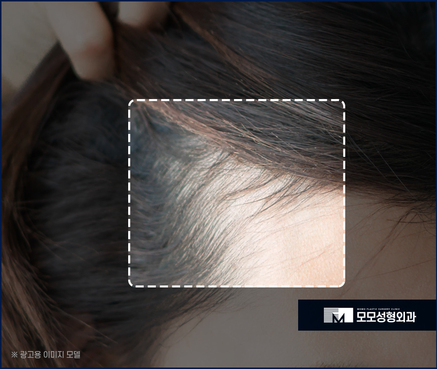 M자 모발이식 비용과 금액대가 달라지는 이유 관련 이미지 3