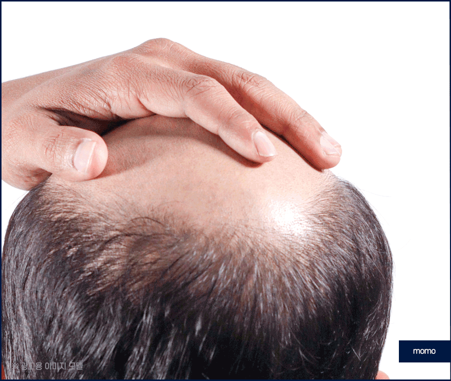 모발이식병원추천 개인에게 맞춰 진단하는 곳으로 관련 이미지 8