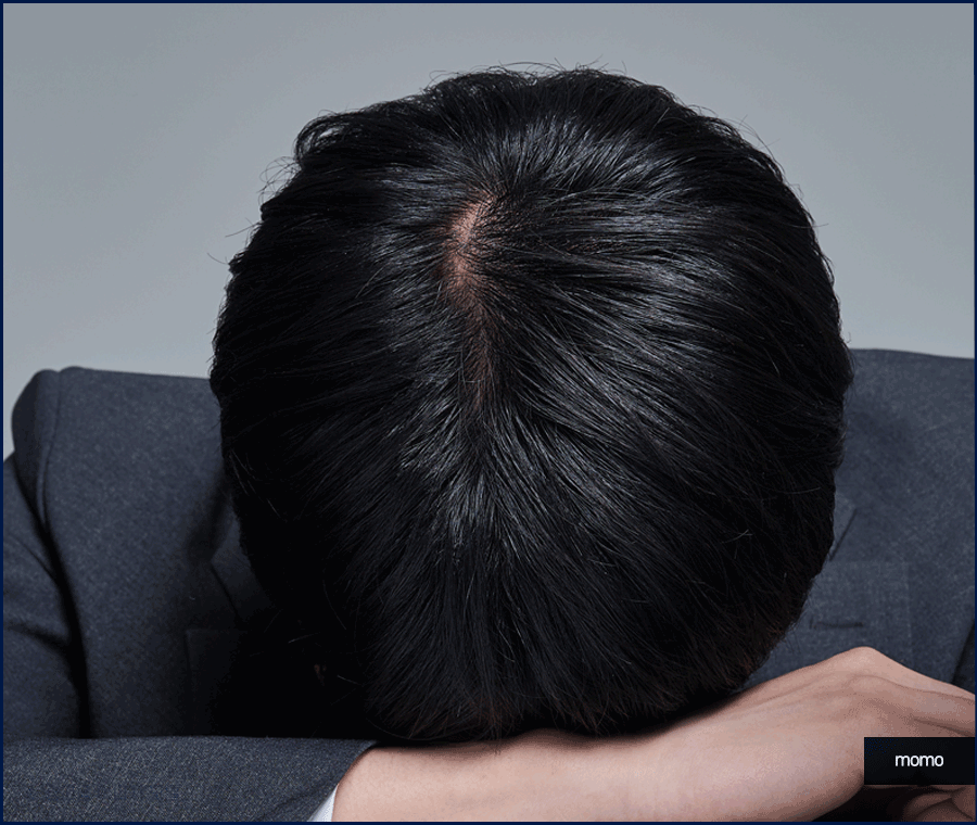 모발이식재수술 원인 및 성공을 위한 핵심 2가지 관련 이미지 4