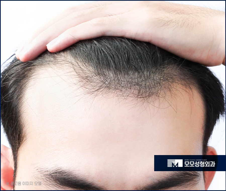 모발이식1000모 한듯 안한듯 자연스러운 관련 이미지 2