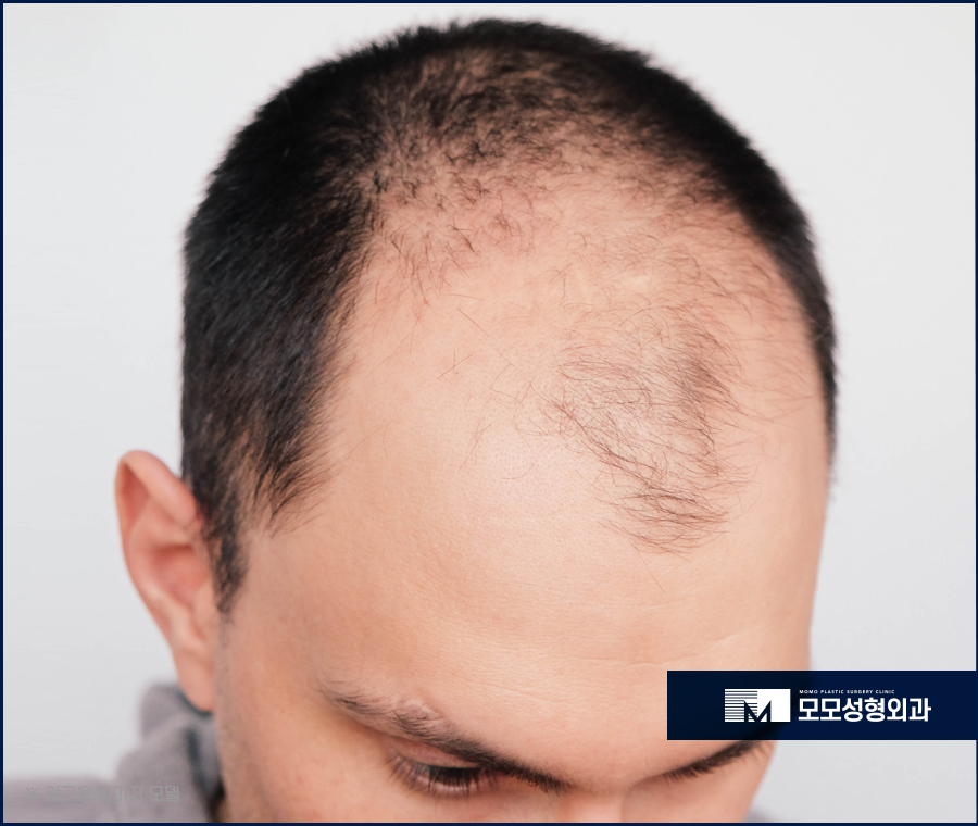 절개모발이식흉터 정도와 흔적이 싫은 상황이라면 관련 이미지 3