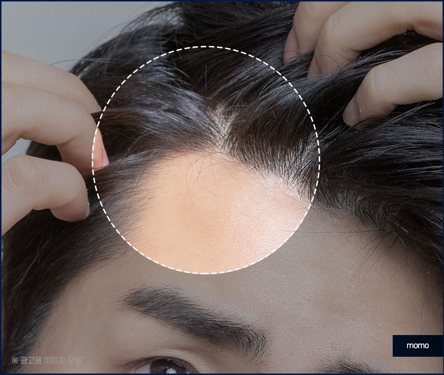 m자탈모초기 현상과 빠르게 대처하면 좋은 포인트는 관련 이미지 10