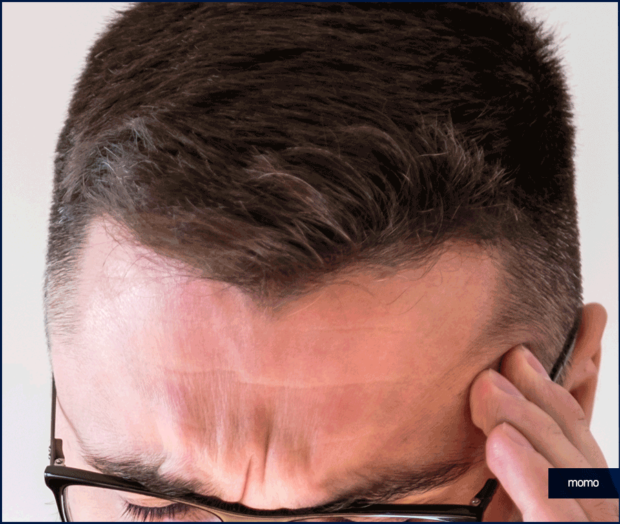 이마 축소술 비용 및 모발이식이 선호되는 이유 관련 이미지 9