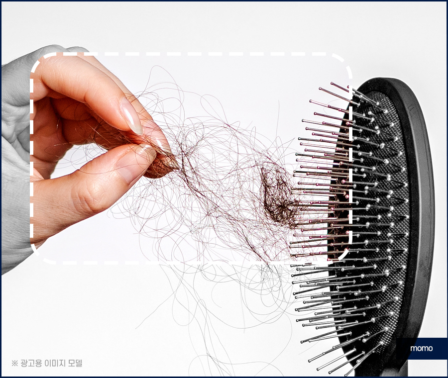 서울모발이식병원 나아지는 과정은 관련 이미지 2