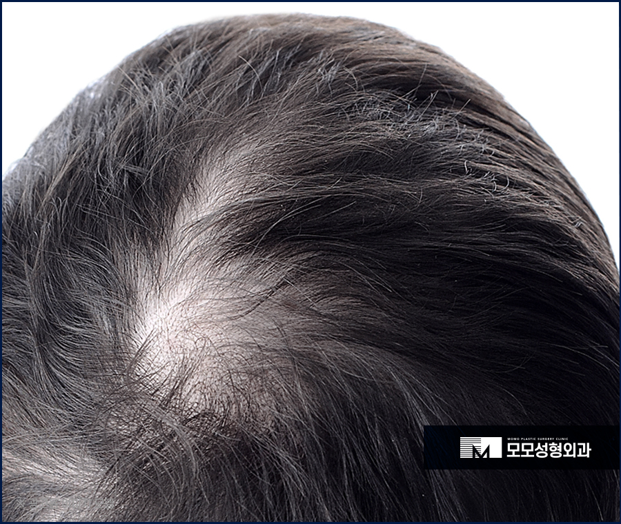 m자탈모모발이식비용 어느 정도가 적절할까요 관련 이미지 7