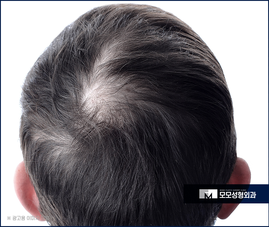 모발이식재수술 만족하기 위해서는 관련 이미지 2