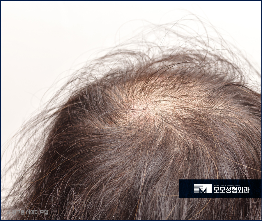 신사모발이식 자연스러움까지 얻어내기 위한 관련 이미지 2