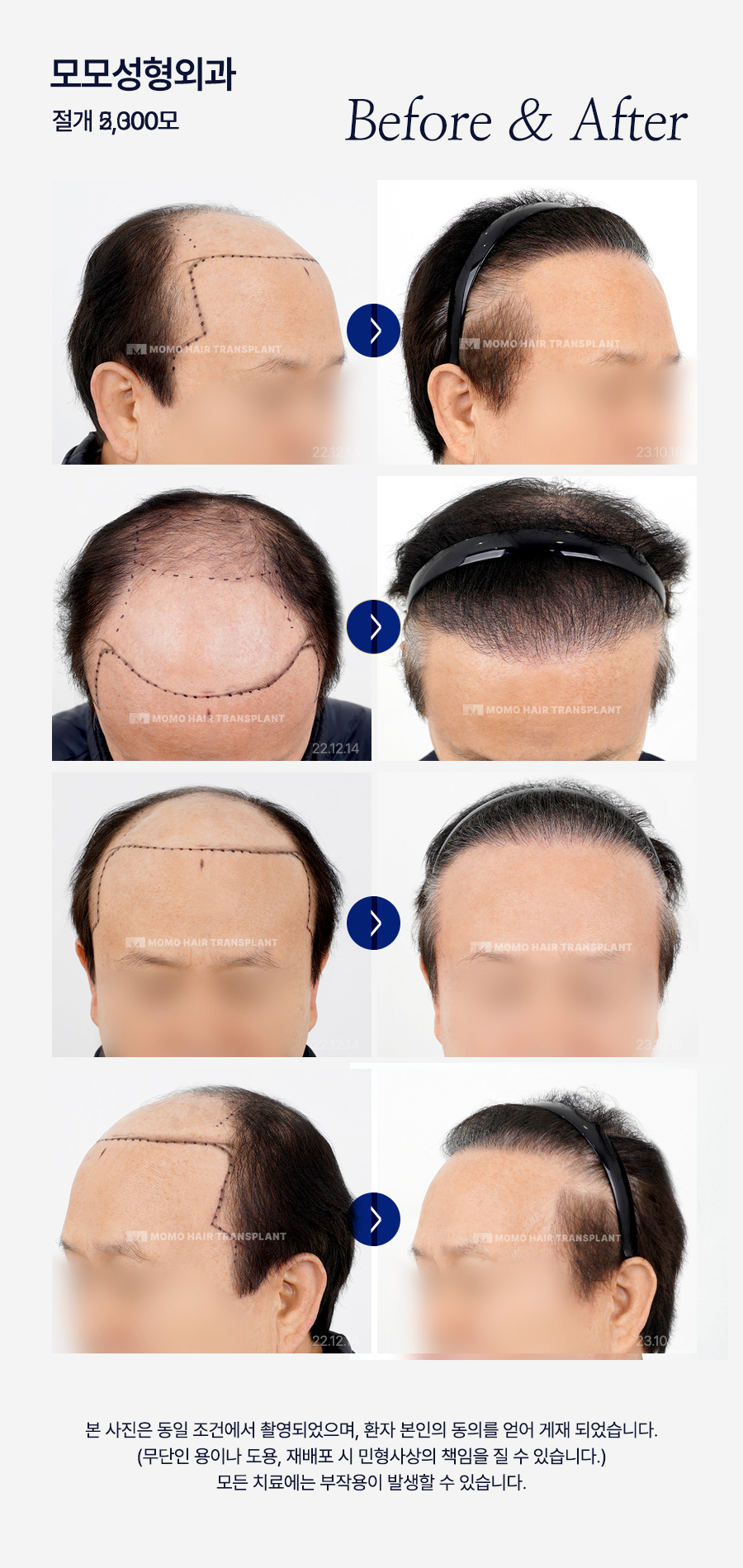 서울 탈모 성지 풍성함을 만들기 위한 방법 2가지 관련 이미지 16