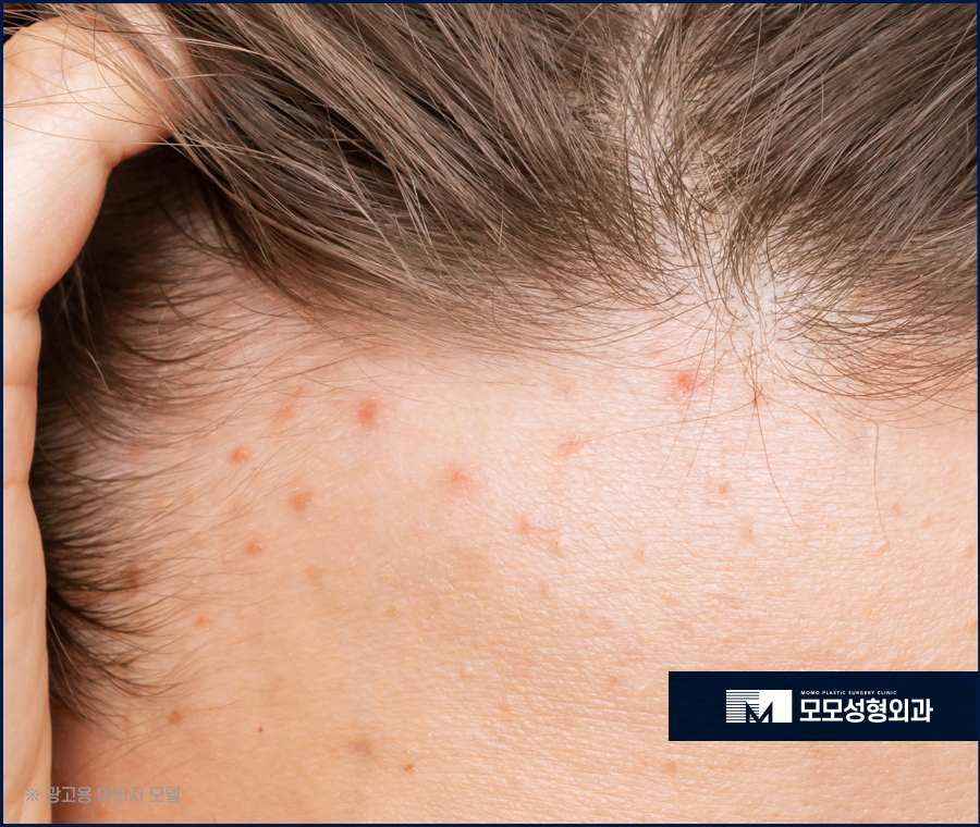 두피 피지알갱이 원인과 없애는 방법은 관련 이미지 5