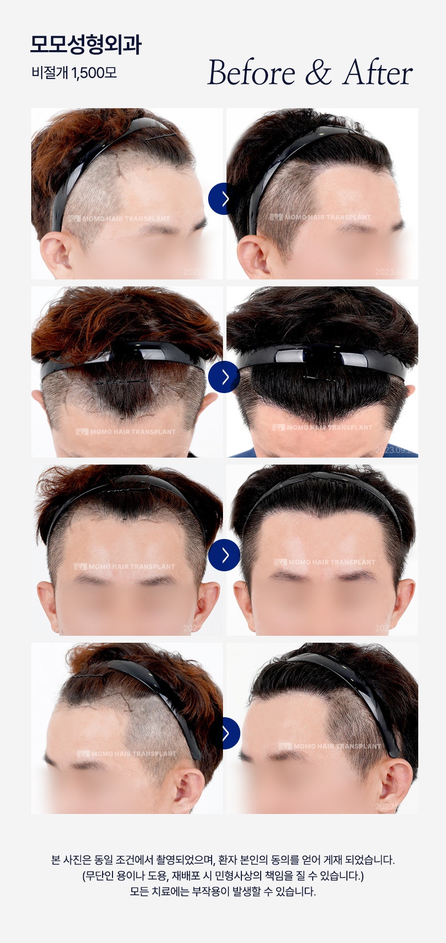 모발이식병원추천 선택 시 꼭 체크할 사항 3가지 관련 이미지 13