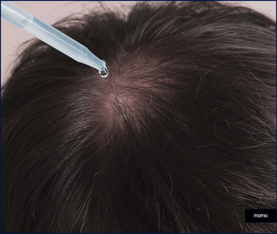 탈모약 처방 및 주의사항, 회복을 위한 대안 관련 이미지 10