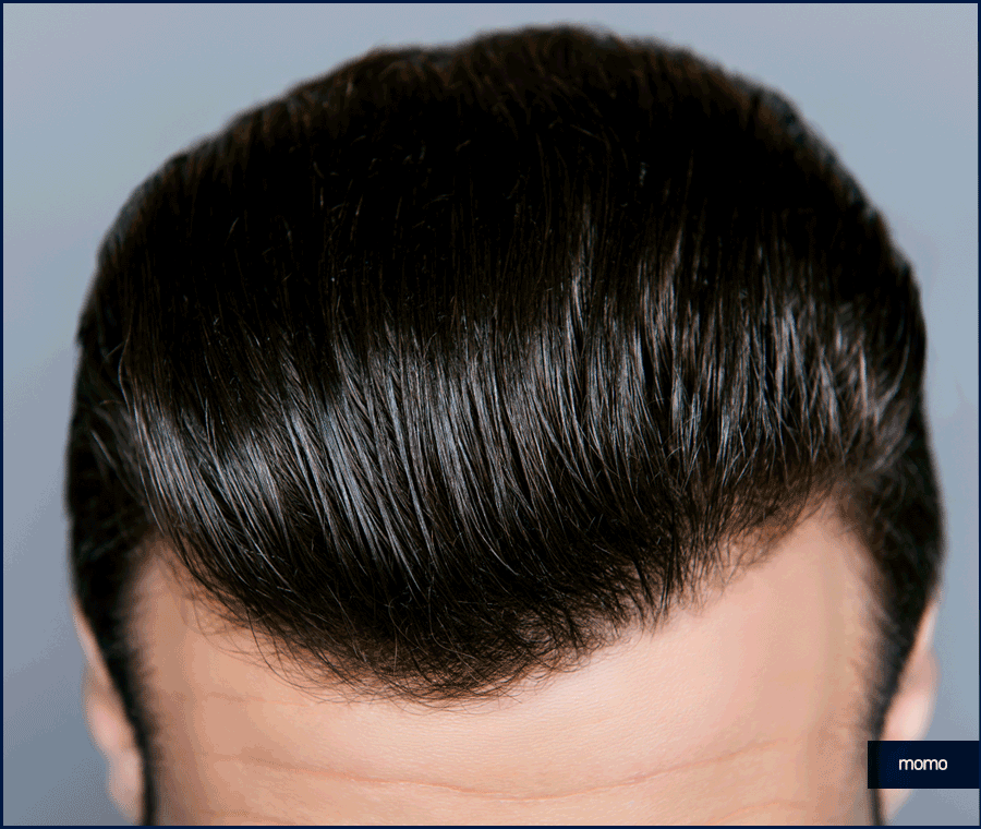 이마 축소술 비용 및 모발이식이 선호되는 이유 관련 이미지 8