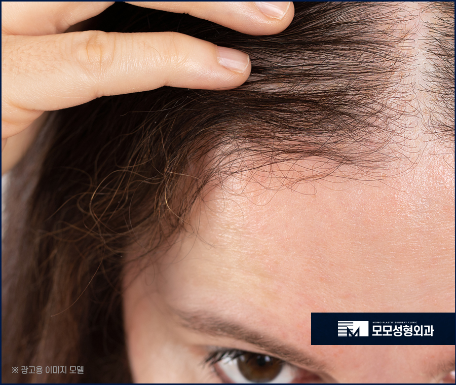 여성 헤어라인 모발이식 미모까지 완벽해 지는 효과 관련 이미지 6
