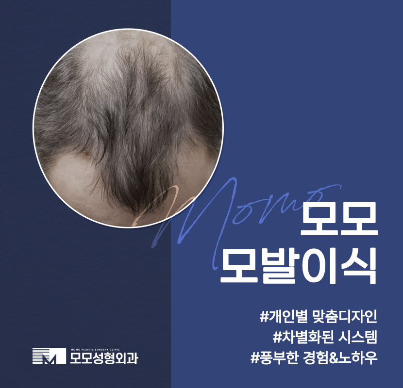 압구정 모발이식 병원 찾고 있다면 꼭 확인하세요 관련 이미지 1