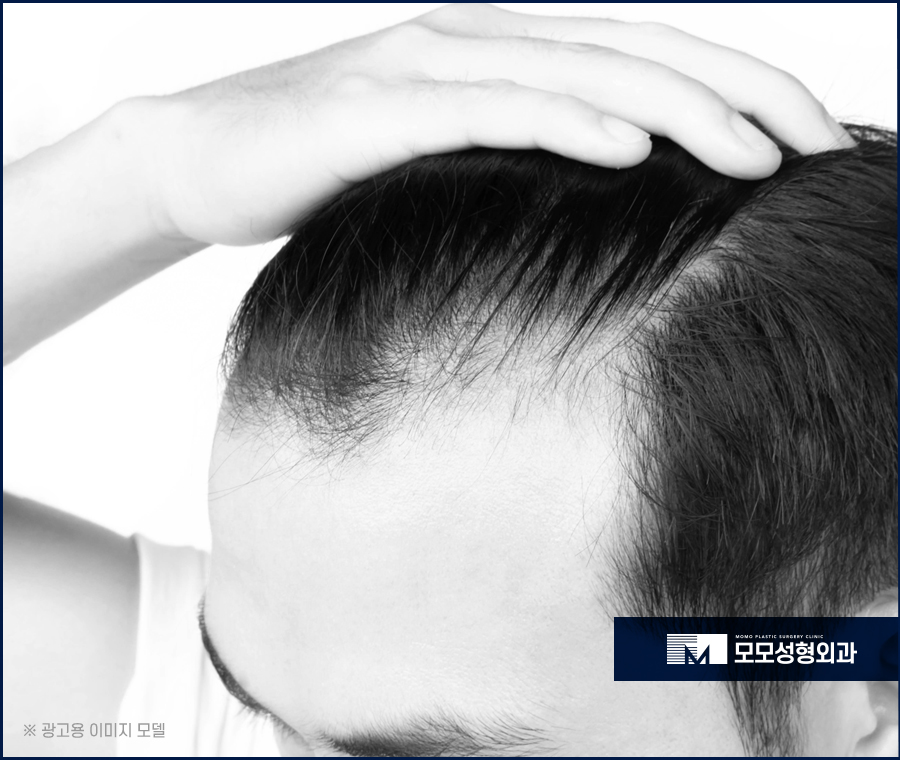 헤어라인교정비용 조건에 부합하는 수준은 관련 이미지 3