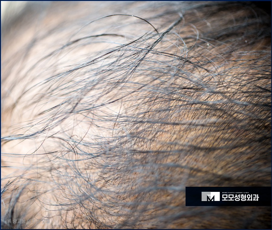 맞춤모발이식 풍성한 결과를 만드는 관련 이미지 4