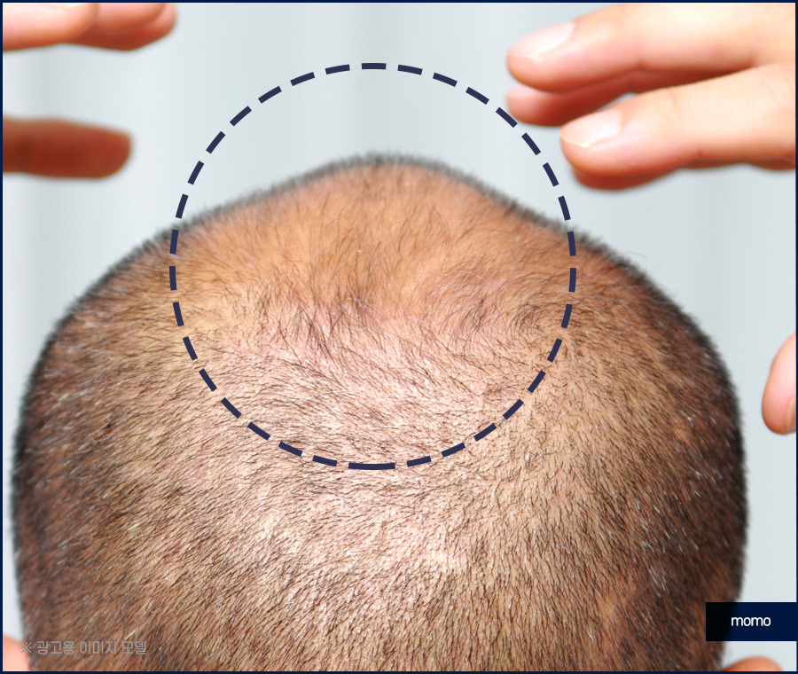 비절개 모발이식 비용 무삭발로 회복까지 빠르게 관련 이미지 13