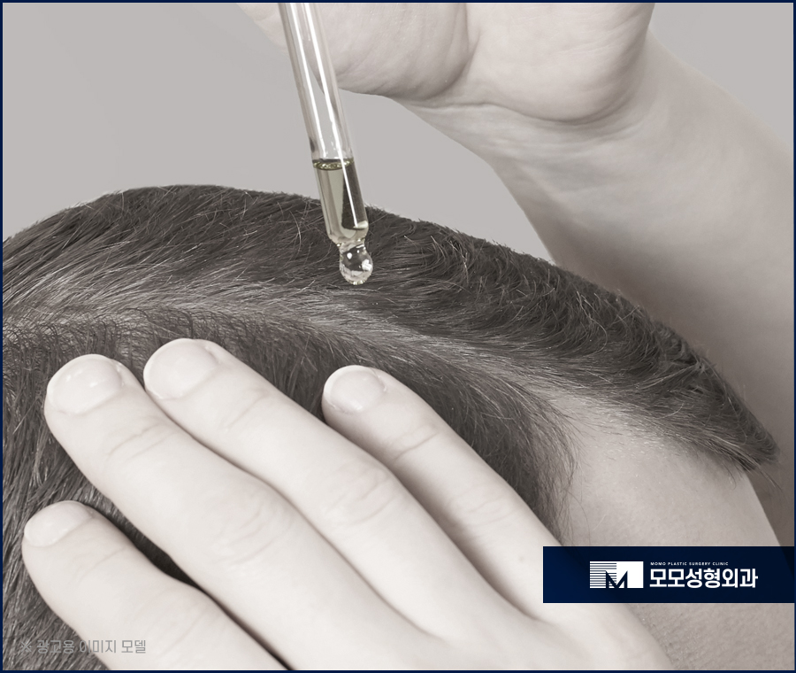 모발이식 6개월 차 변화와 유의할 점에 대해서 관련 이미지 4