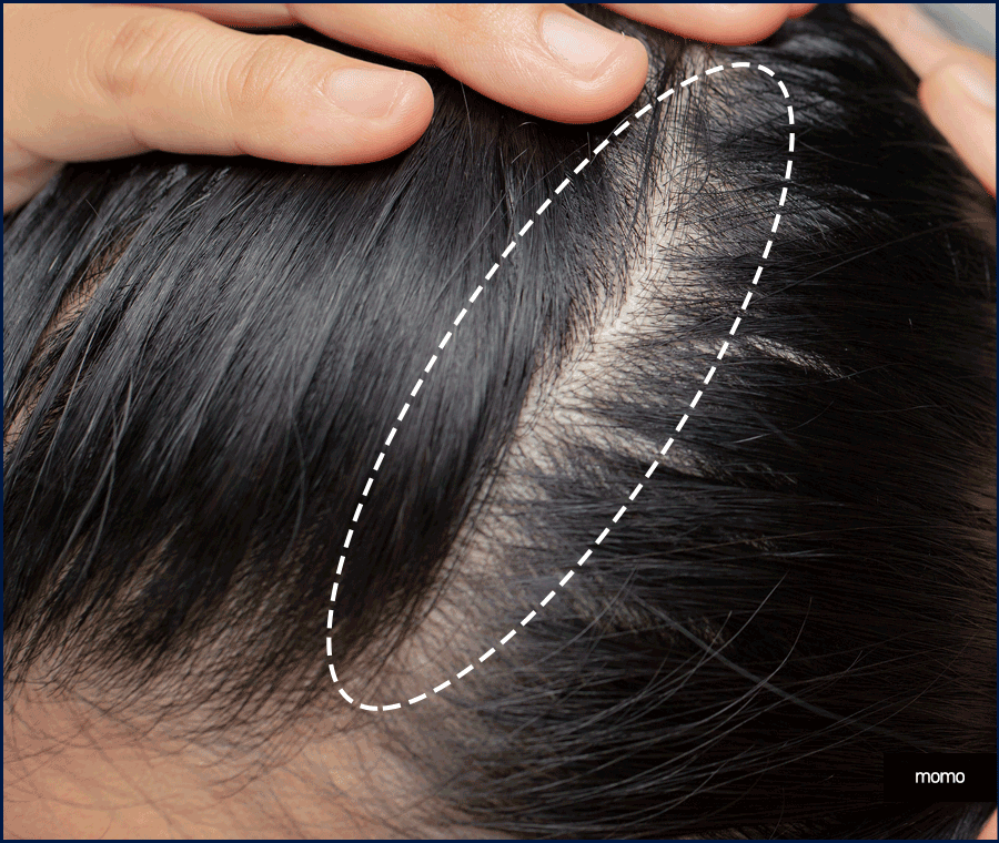 남자 모발이식 비용, 방법까지 꼼꼼히 확인하세요! 관련 이미지 6