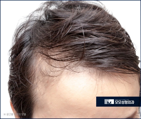 남자머리심기 신속한 일상 회복을 위한 방법 (ft. 비절개모발이식) 관련 이미지 11