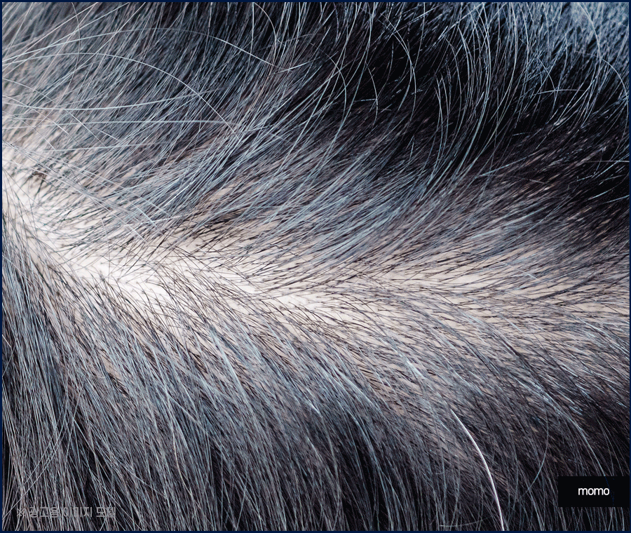 머리심기 비용 및 시술별 장단점 알아보기 관련 이미지 11